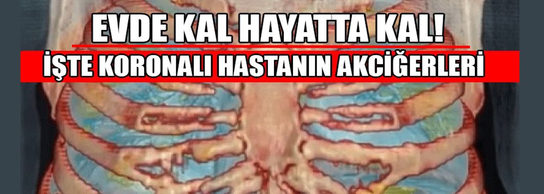 Koronalı Hastanın Akciğerleri Görüntülendi