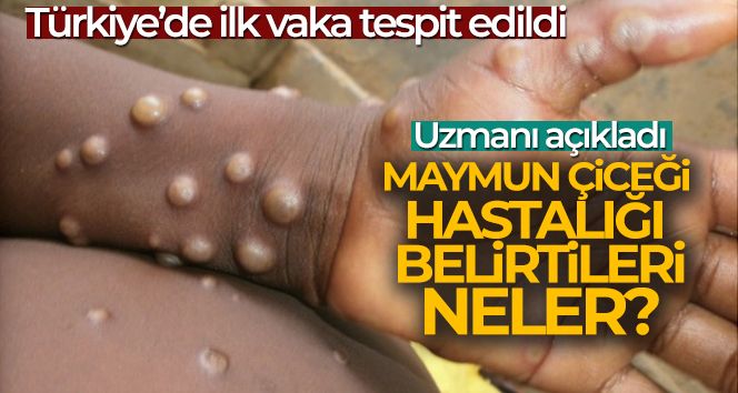 Maymun Çiçeği nedir? Maymun Çiceği belirtileri neler!