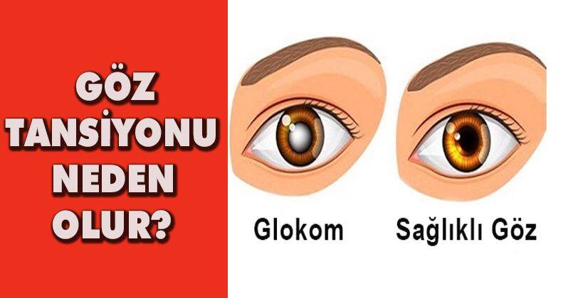 Göz Tansiyonu Neden Olur? Nelere Dikkat Edilmeli? Sağlık Haberleri Düzce Tv