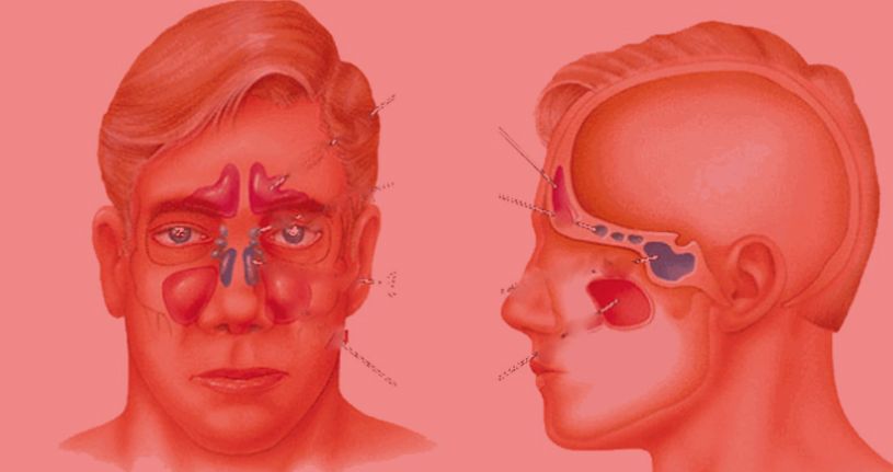 Sinüzit belirtilerine dikkat