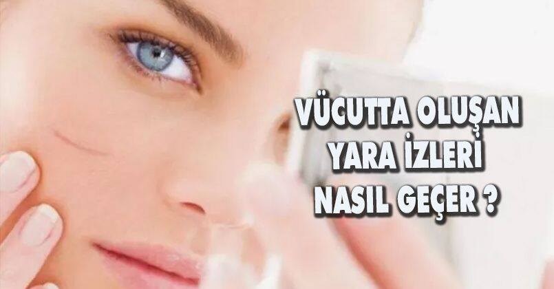 Vücutta Oluşan Yara İzleri  Nasıl Geçer?