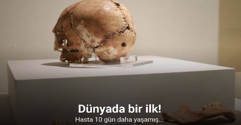 Dünyanın ilk beyin ameliyatına ait kafatası