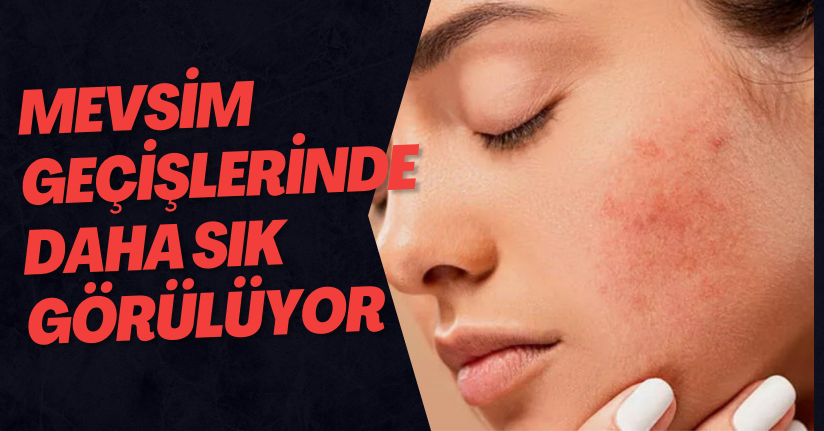 Mevsim Geçişlerinde Daha Sık Görülüyor