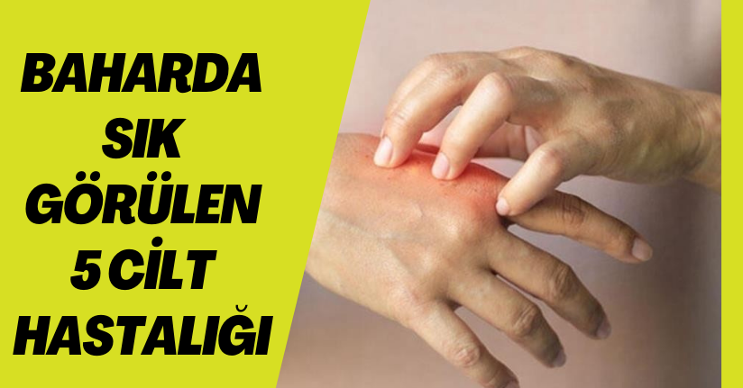 Baharda sık görülen 5 cilt hastalığı