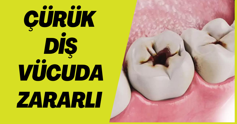 Çürük Diş Vücuda Zararlı