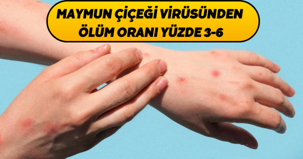 Maymun çiçeği virüsünden ölüm oranı yüzde 3-6
