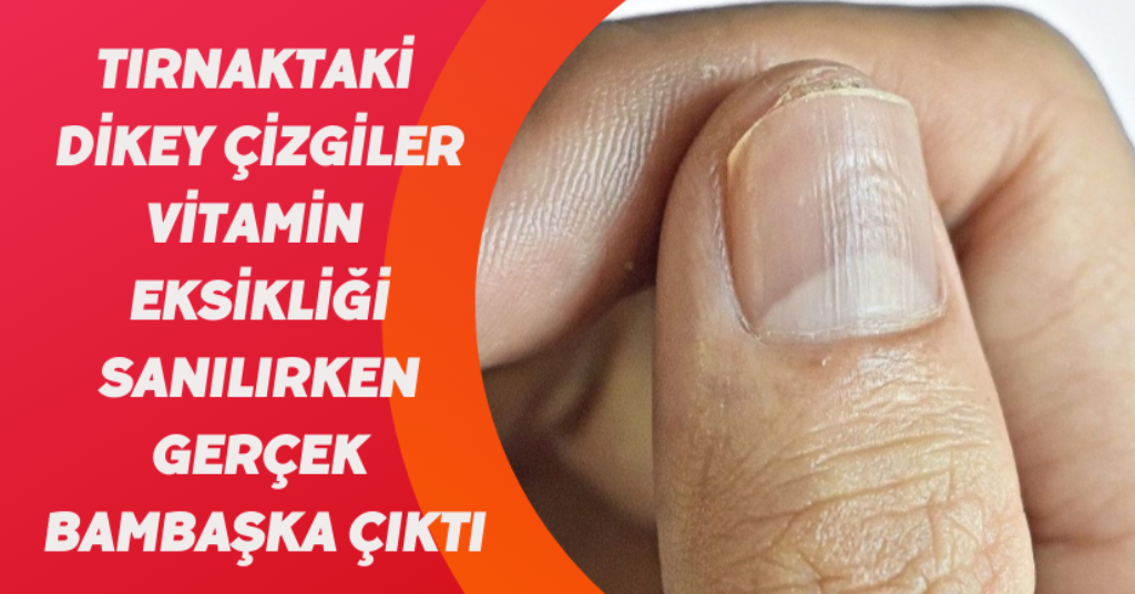 Tırnaktaki dikey çizgiler, vitamin eksikliği sanılırken gerçek bambaşka çıktı