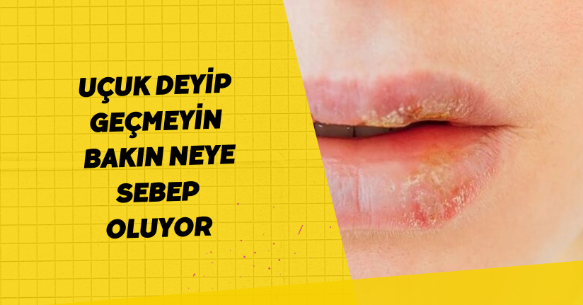 Uçuk deyip geçmeyin, bakın neye sebep oluyor
