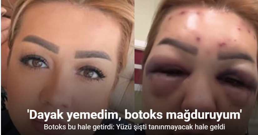 Botoks bu hale getirdi: Yüzü şişti tanınmayacak hale geldi