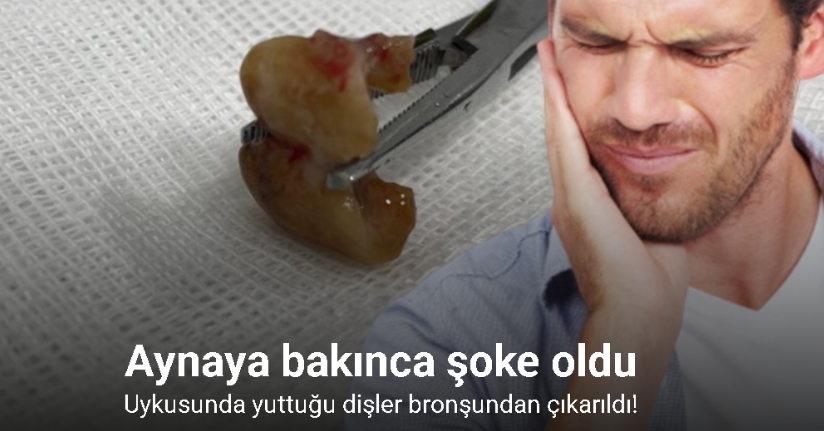 Uykusunda yuttuğu dişler bronşundan çıkarıldı