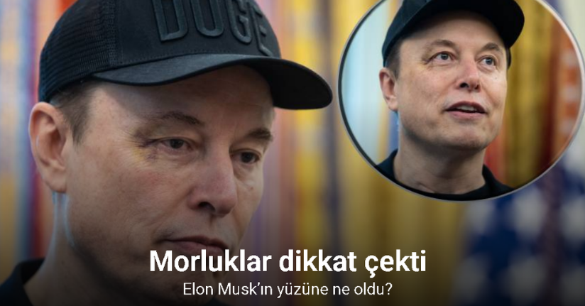 Elon Musk’ın yüzüne ne oldu? İlk kez açıkladı