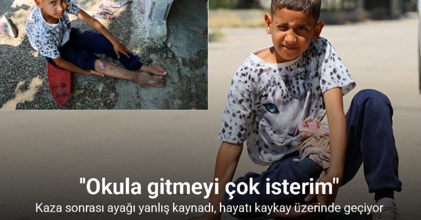 Kaza sonrası ayağı yanlış kaynadı, hayatı kaykay üzerinde geçiyor