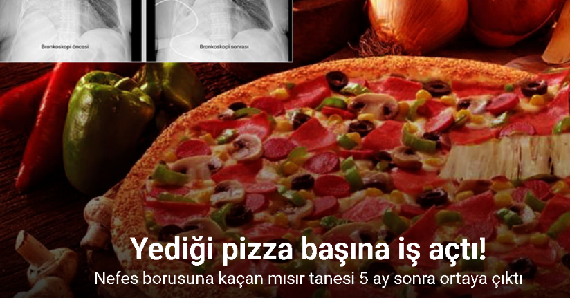 Nefes borusuna kaçan mısır tanesi 5 ay sonra ortaya çıktı