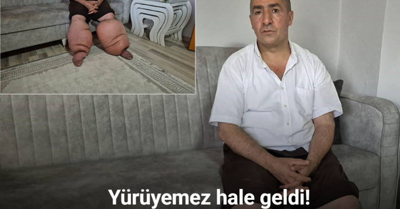 15 yıldır fil hastalığıyla mücadele ediyor