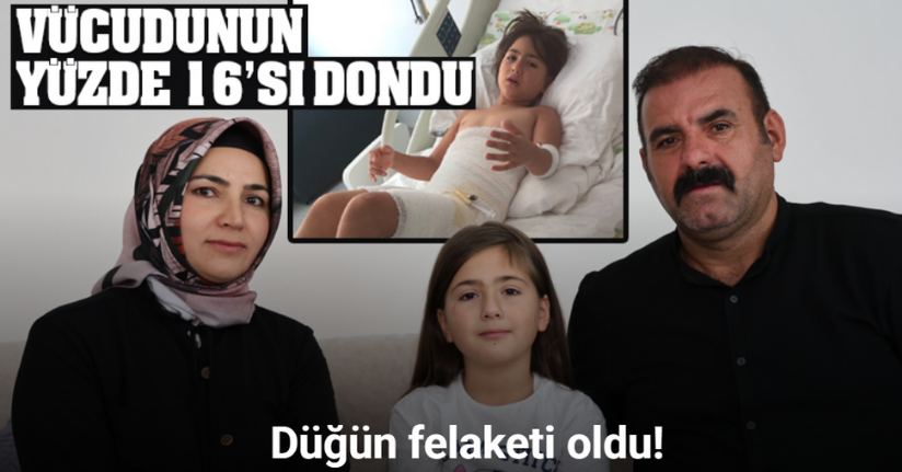 Düğün felaketi oldu: 8 yaşındaki Elif, 7 operasyon geçirdi