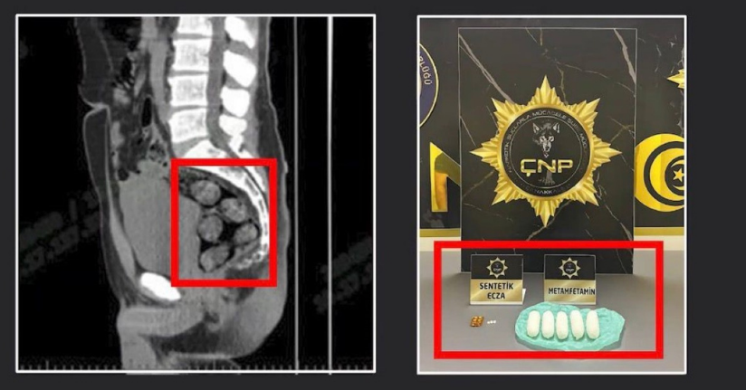 Tomografide şok eden görüntü...Uyuşturucu midesinden çıkarıldı