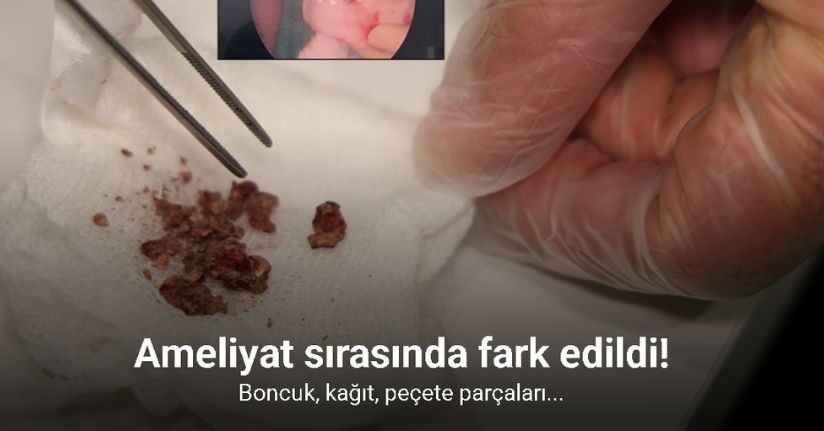 Elazığ’da estetik ameliyatta şaşırtan olay, burundan taş çıktı