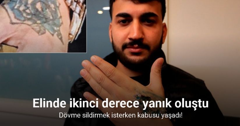 Dövme sildirmek isterken kabusu yaşadı, elindeki dokular öldü