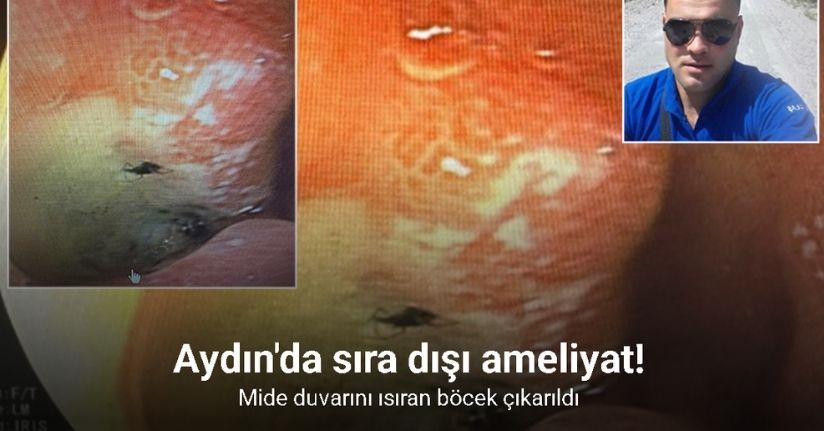 İlginç ama gerçek: Aydın’da bir şahsın karnına giren böcek ameliyatla anıldı
