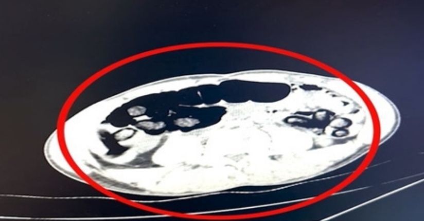 Batman'da 4 şüphelinin midesinden 2 kilo 700 gram uyuşturucu çıktı