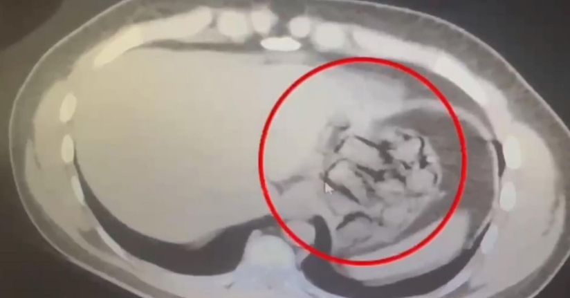 Midesinden 76 parça halinde 571 gram metamfetamin çıkarıldı