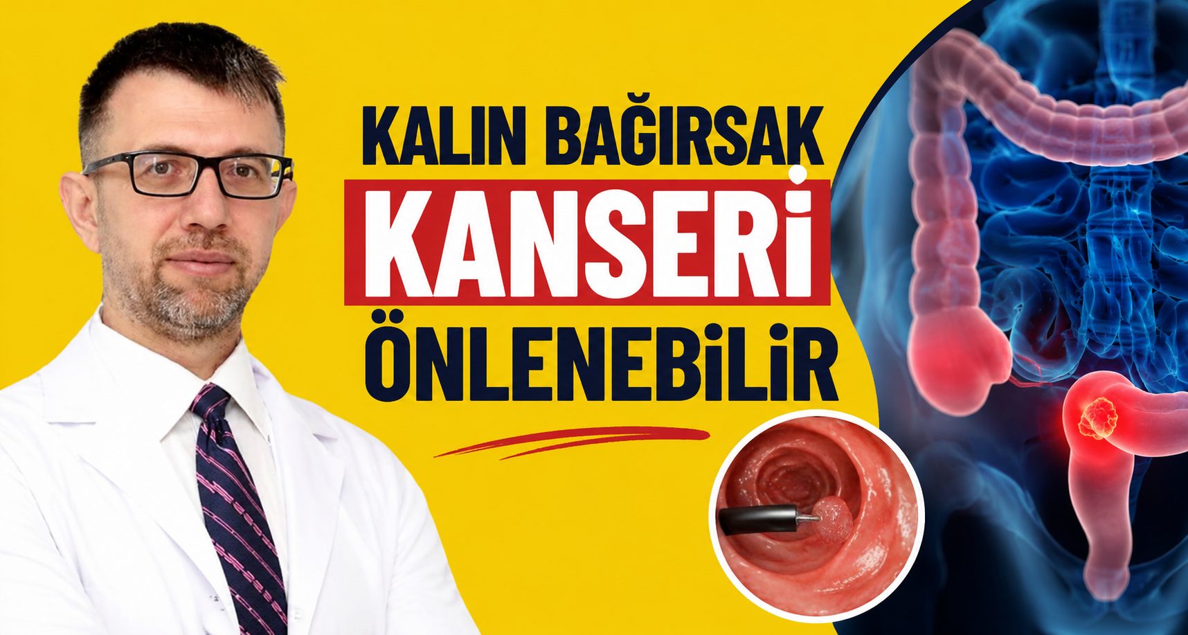 Kalın bağırsak kanseri önlenebilir