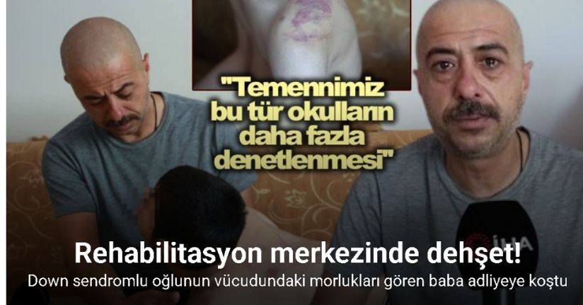 Down sendromlu oğlunun vücudundaki izleri görünce soluğu önce hastanede ardından adliyede aldı