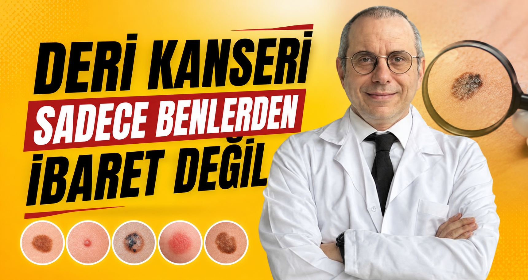 Deri kanseri sadece benlerden ibaret değil