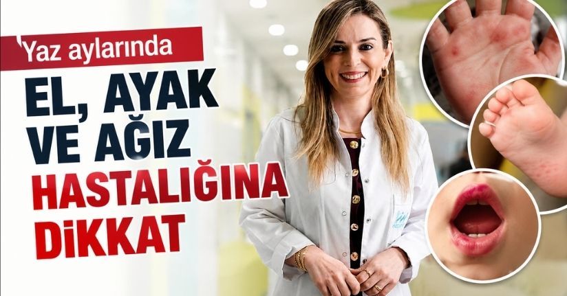 Yaz aylarında el, ayak ve ağız hastalığına dikkat