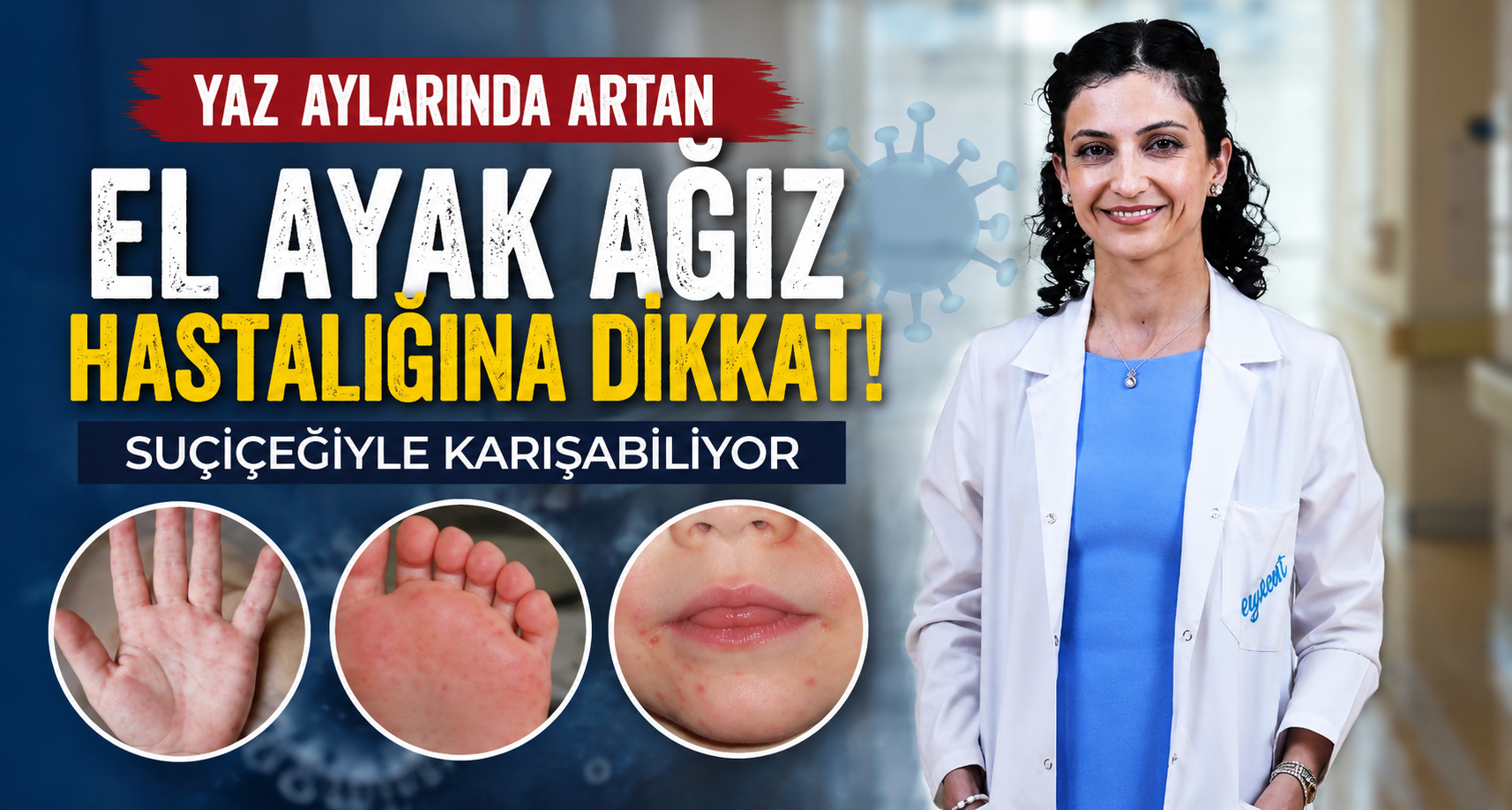 Yaz aylarında artan el ayak ağız hastalığına dikkat: Suçiçeğiyle karışabiliyor