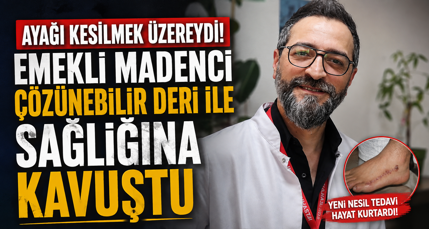 Ayağı kesilmek üzere olan emekli madenci, çözünebilir deri ile sağlığına kavuştu