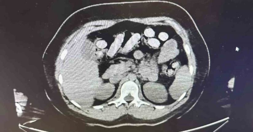 1.5 kilo metamfetamin iki kadın kuryenin bağırsak ve midesinden çıktı