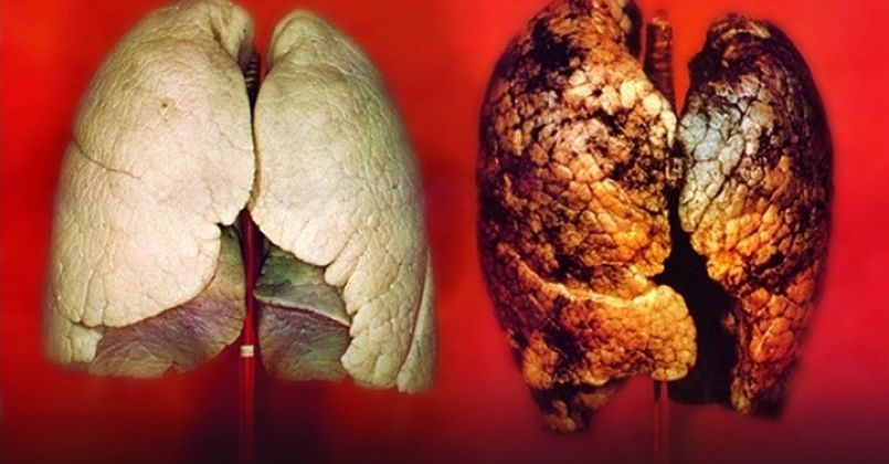 Beta karoten akciğer kanseri riskini arttırıyor