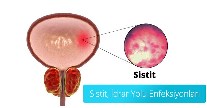 İdrar Tutmak Sistit Hastalığını Tetikliyor!